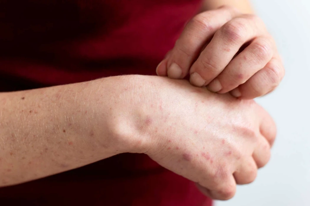 Pharmacy First Shingles Image